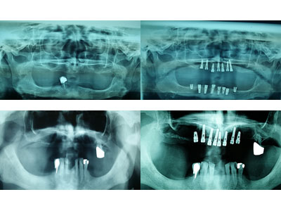 DENTAL IMPLANT Dental surgery Belgrade - Photo 10