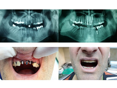 DENTAL IMPLANT Dental surgery Belgrade - Photo 12